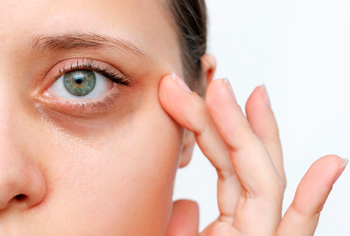 como diminuir olheiras escuras