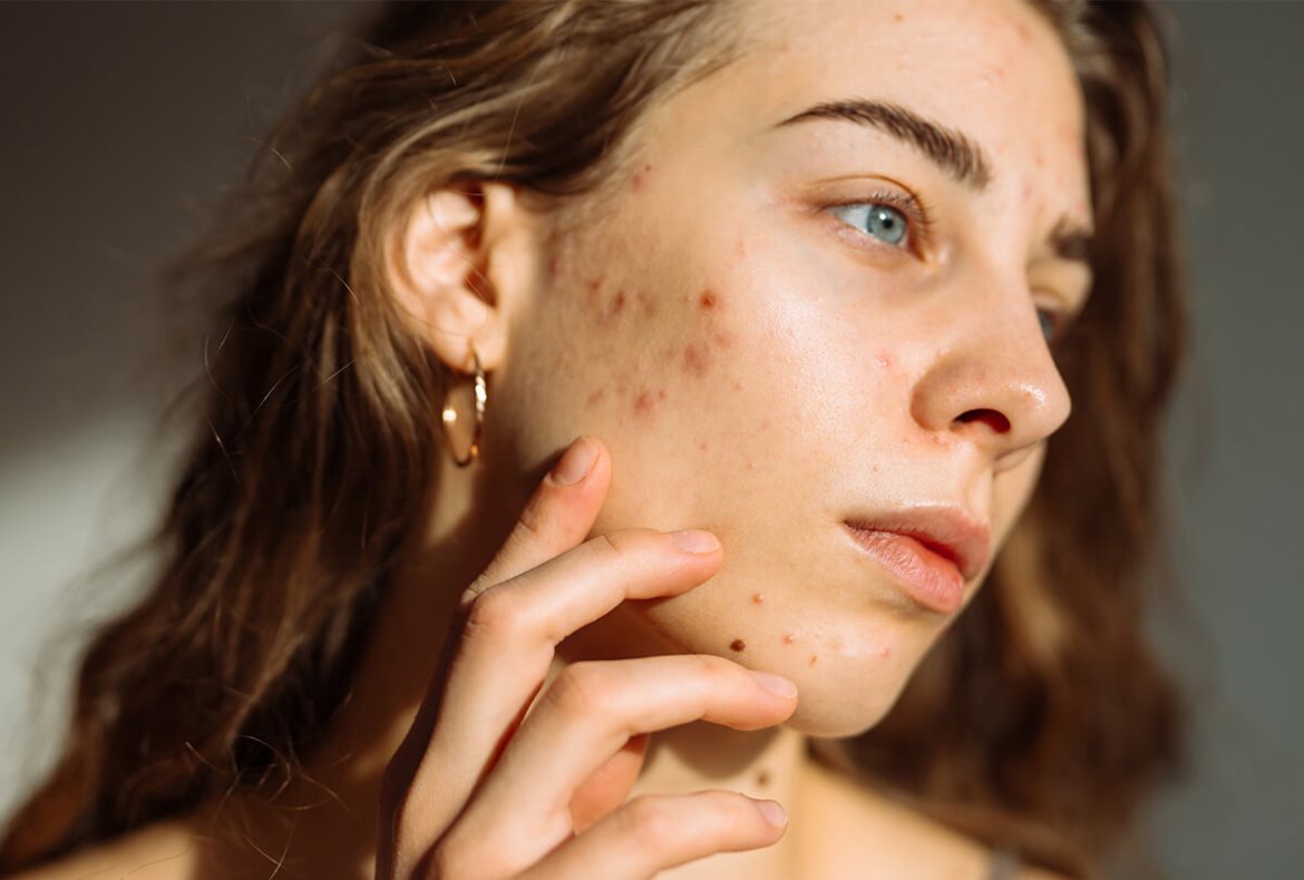 como acabar com a acne