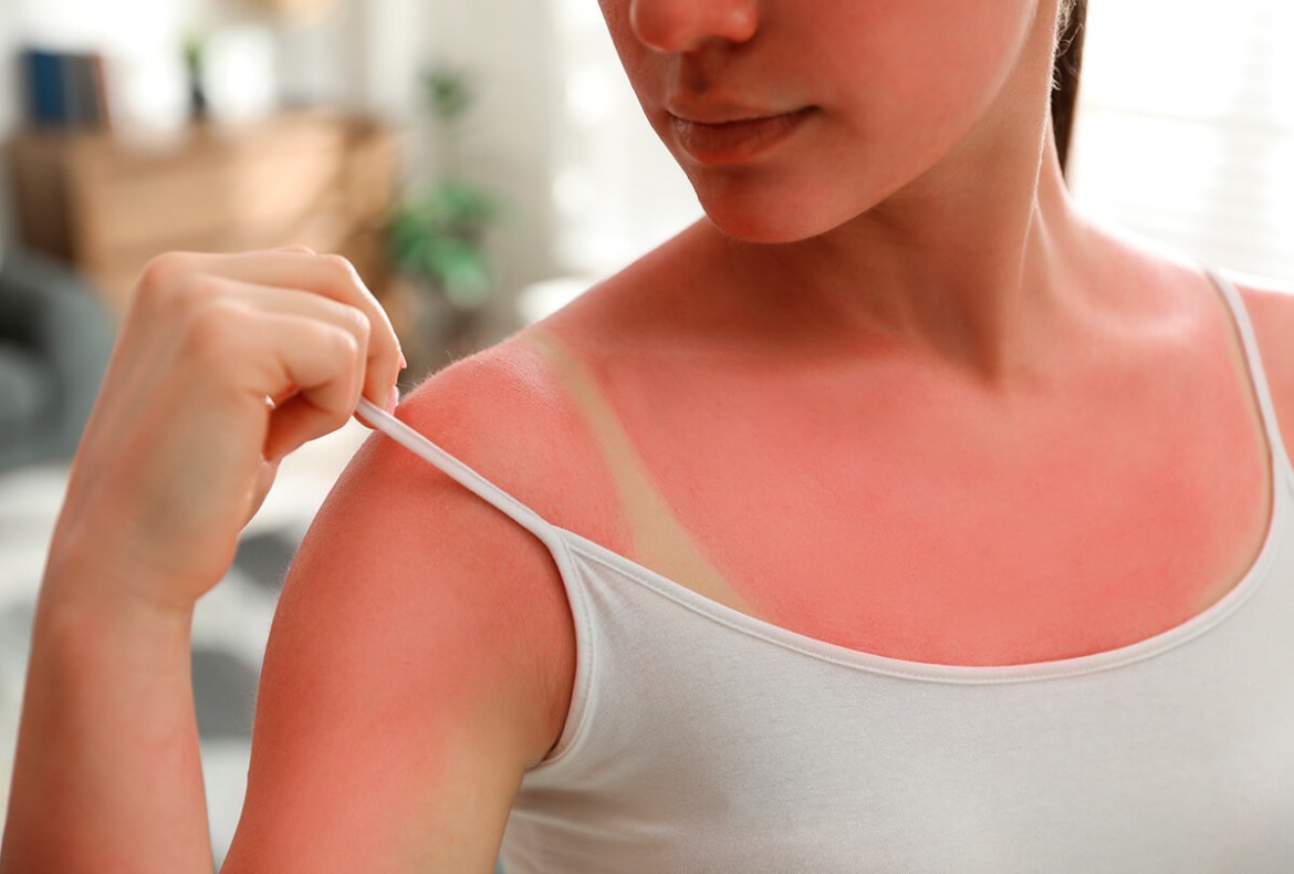 mulher mostrando queimadura do sol na pele com vermelhidão