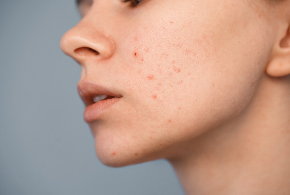 Como cuidar da pele com acne e manchas